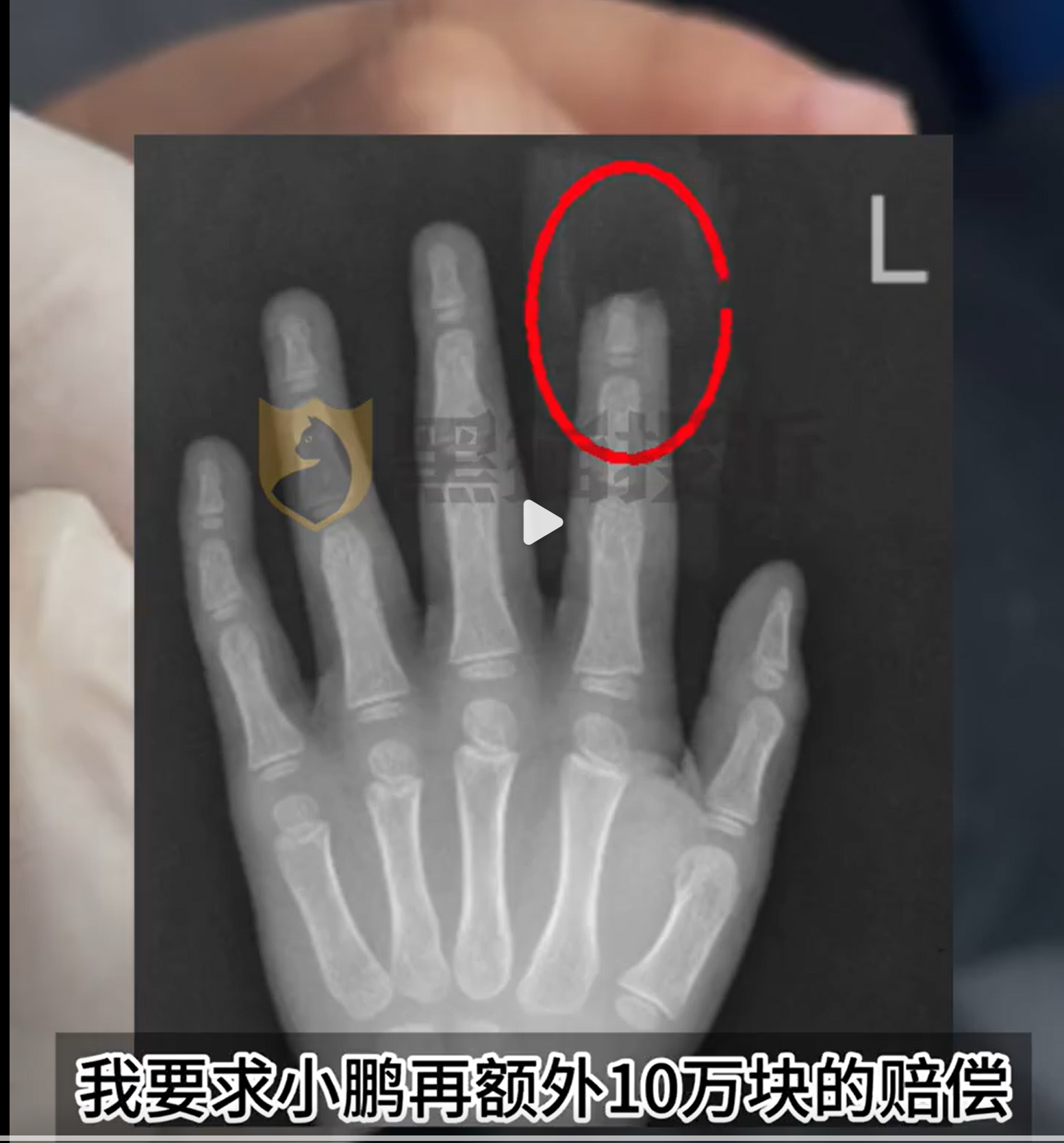 小鹏X9屏幕夹断5岁男童半节食指,家长索赔10万