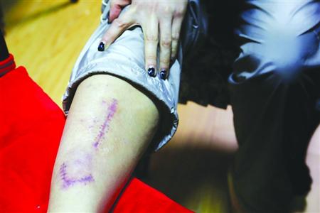 健身骑单车划伤小腿缝近百针 一兆韦德拒赔整形费用